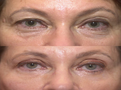 Lower Eyelid Surgery