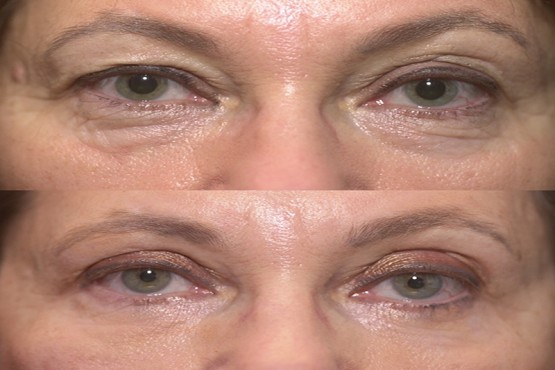 Lower Eyelid Surgery