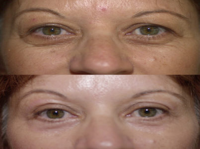 eyelidslower12