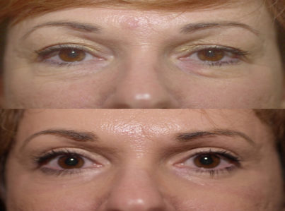 Lower Eyelid Surgery