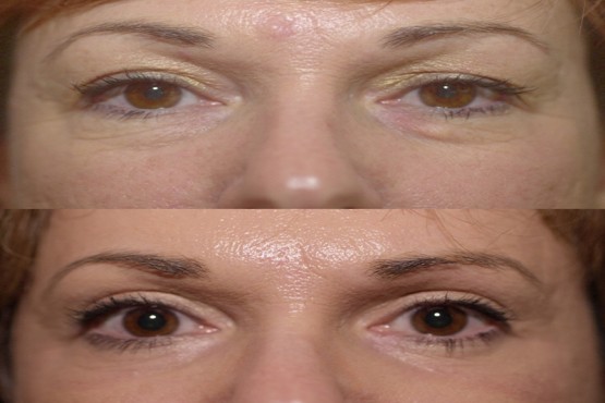 Lower Eyelid Surgery