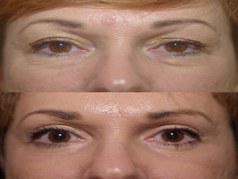 Lower Eyelid Surgery