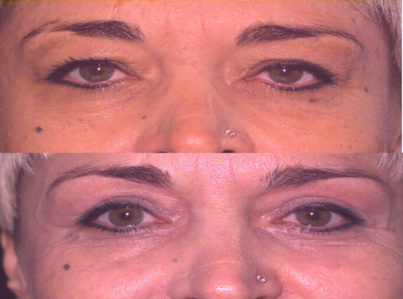 Lower Eyelid Surgery