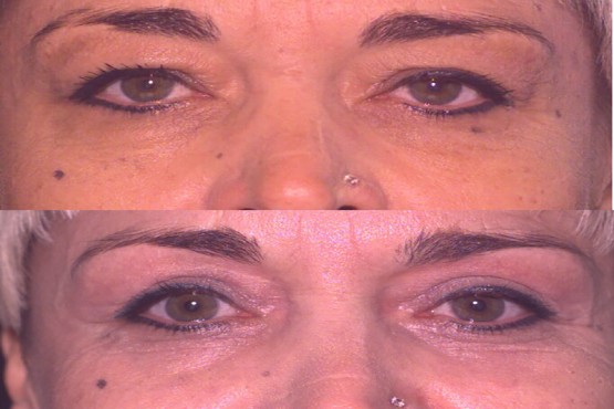 Lower Eyelid Surgery