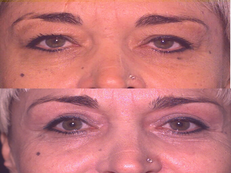 Lower Eyelid Surgery
