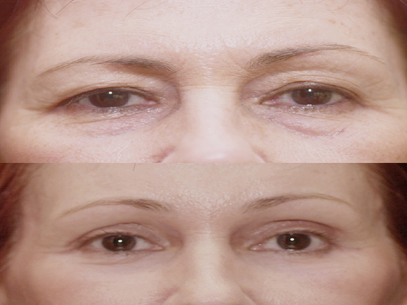 Lower Eyelid Surgery