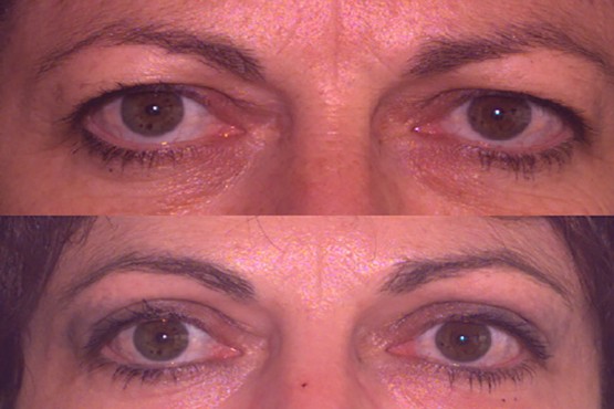 Lower Eyelid Surgery
