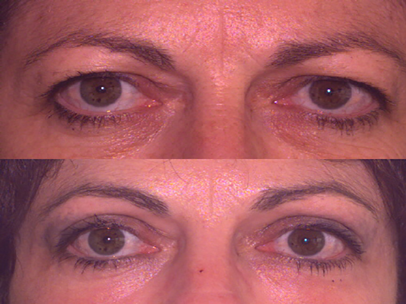 Lower Eyelid Surgery