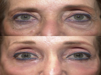 Lower Eyelid Surgery