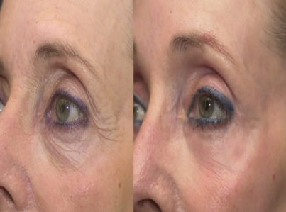 Lower Eyelid Surgery