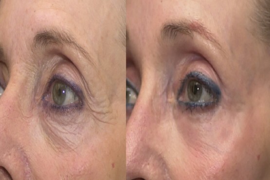 Lower Eyelid Surgery