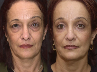 Lower Eyelid Surgery