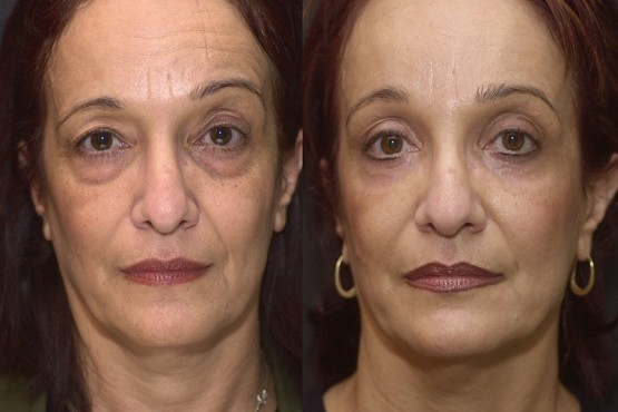 Lower Eyelid Surgery