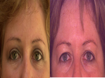 Lower Eyelid Surgery