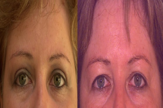 Lower Eyelid Surgery