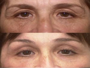 Lower Eyelid Surgery
