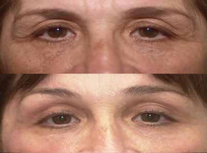 Lower Eyelid Surgery