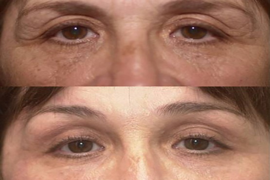 Lower Eyelid Surgery