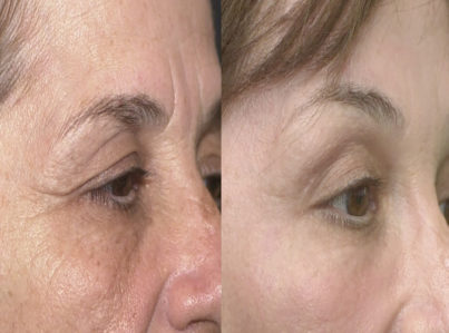 Lower Eyelid Surgery