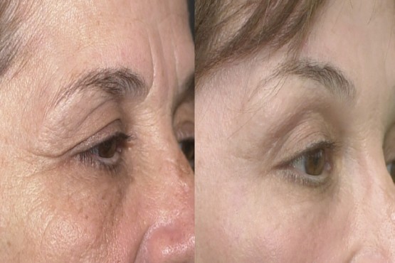 Lower Eyelid Surgery