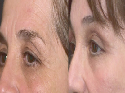 Lower Eyelid Surgery