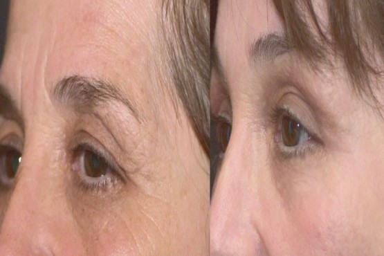 Lower Eyelid Surgery