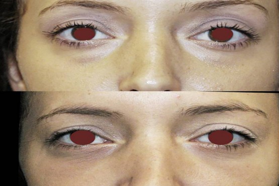 Lower Eyelid Surgery