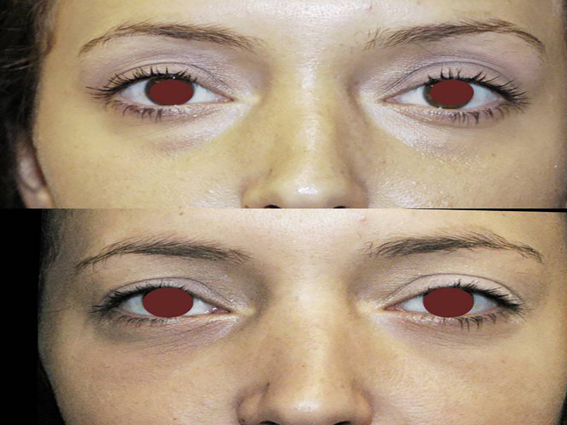 Lower Eyelid Surgery