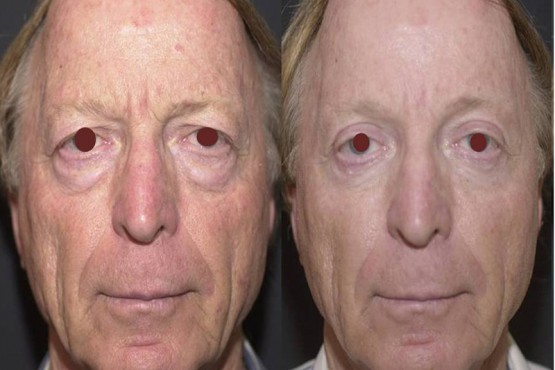 Lower Eyelid Surgery