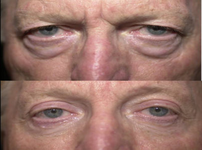 Lower Eyelid Surgery