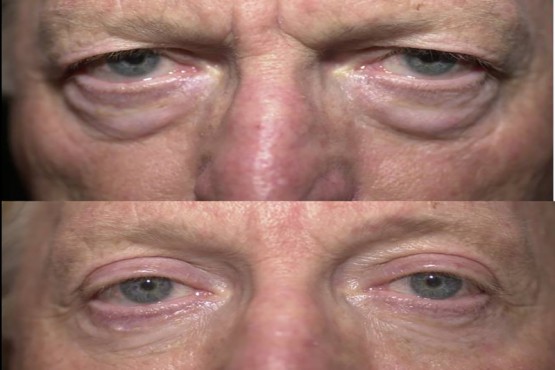 Lower Eyelid Surgery