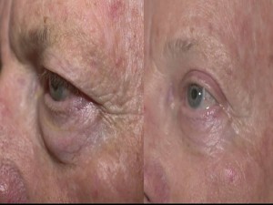 Lower Eyelid Surgery