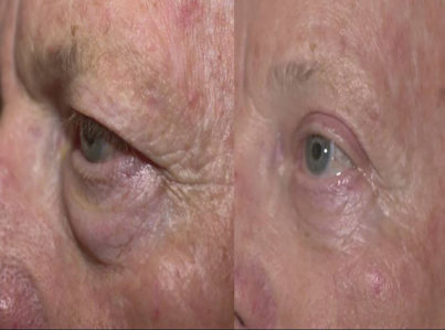 Lower Eyelid Surgery