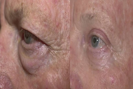 Lower Eyelid Surgery