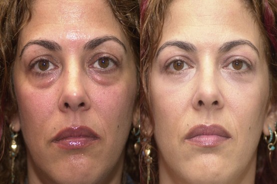 Lower Eyelid Surgery