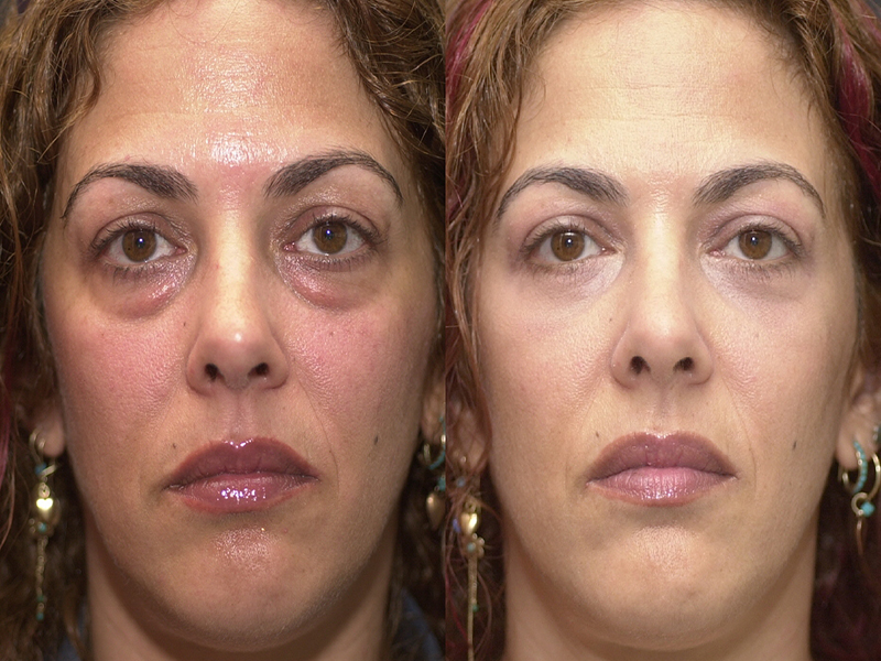 Lower Eyelid Surgery