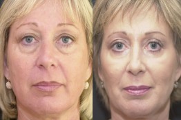 Lower Eyelid Surgery