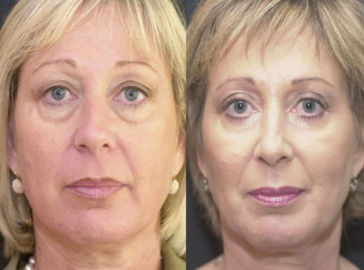 Lower Eyelid Surgery