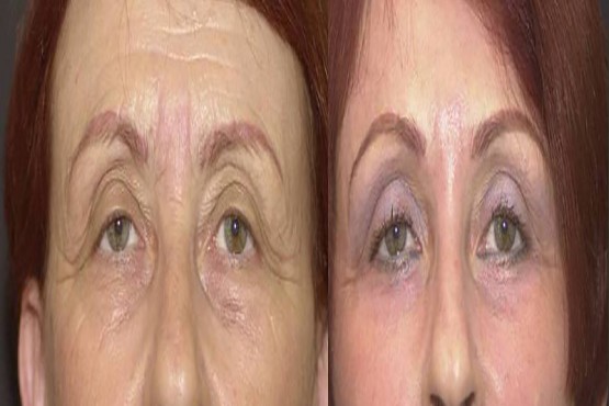 Lower Eyelid Surgery