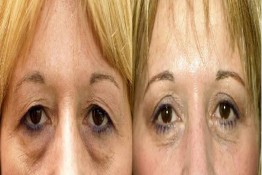 Lower Eyelid Surgery