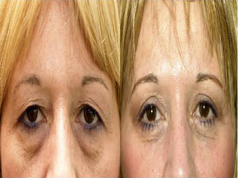 Lower Eyelid Surgery