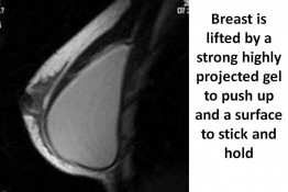 Breast Lift by Implant Alone Surgery