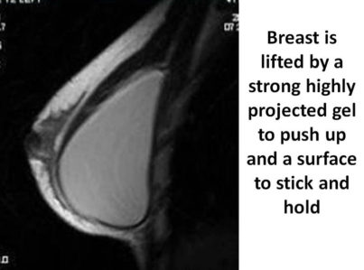 Breast Lift by Implant Alone Surgery