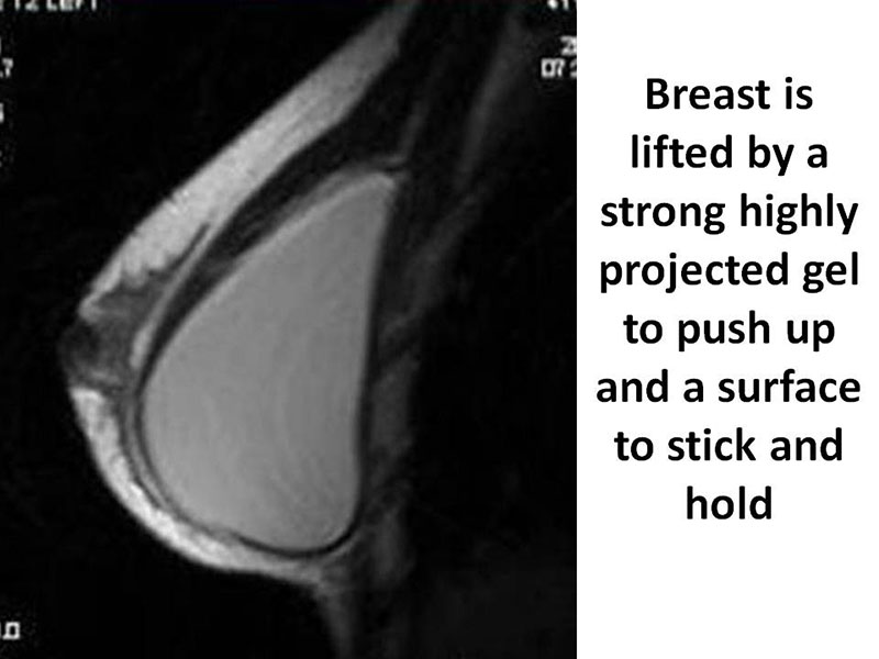 Breast Lift by Implant Alone Surgery