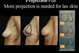 Breast Lift by Implant Alone Surgery