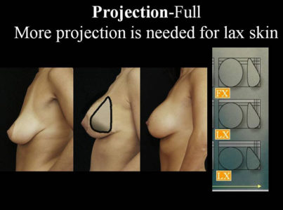 Breast Lift by Implant Alone Surgery