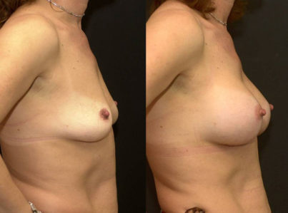 Breast Lift by Implant Alone Surgery