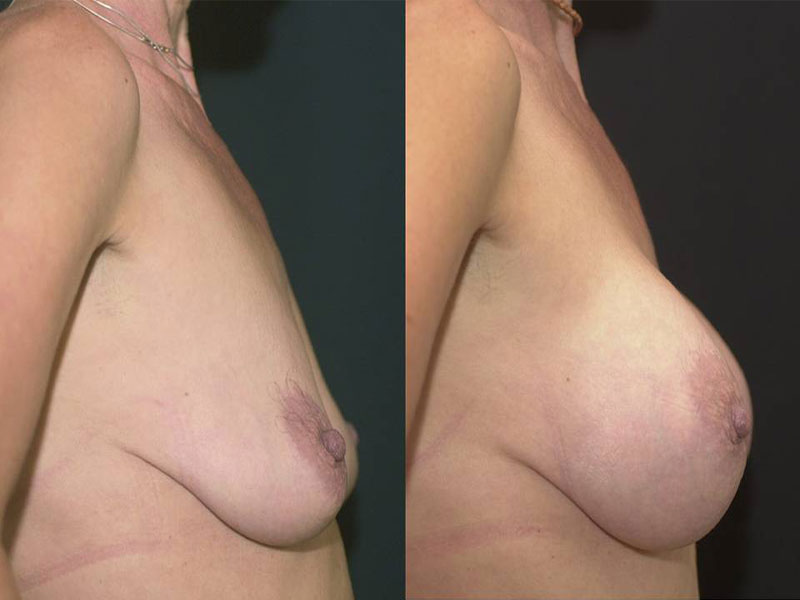 Breast Lift by Implant Alone Surgery