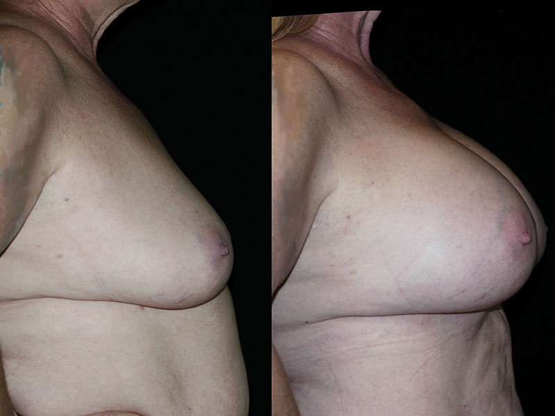 Breast Lift by Implant Alone Surgery