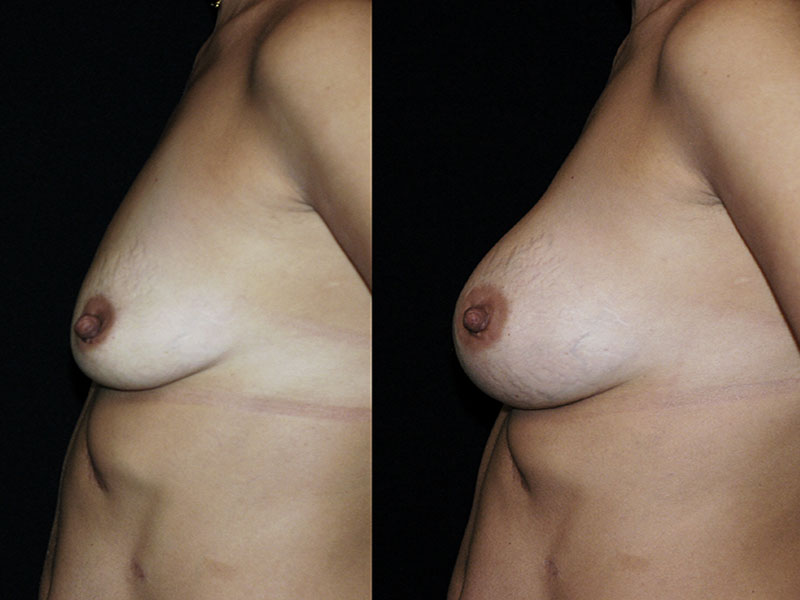 Breast Lift by Implant Alone Surgery